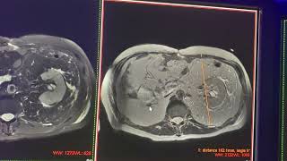 Mielolipoma vs lipoma perirrenal gigante vs liposarcoma retroperitoneal [upl. by Aziaf]