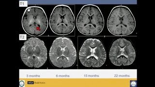 Neuroimaging of Pediatric Disease [upl. by Loriner]