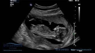 Scan of the Week 15 Weeks Pregnant The Advanced Early Ultrasound [upl. by Schaper]