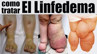 ¿PIERNAS HINCHADAS🦶🏼 Cuidado 🚫 Tratamiento Para Pies Hinchados 🦵 Dr IVÁN GUTIÉRREZ 🦶🏼 Flebocenter [upl. by Odinevneib509]