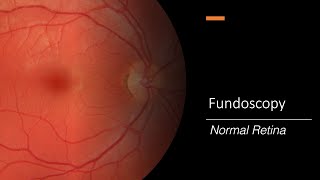 Healthy Retina Fundoscopy [upl. by Cynthie337]