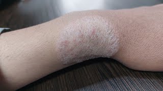 Plaque psoriasis  Different photos  Symptoms diagnosis treatment amp prevention [upl. by Dodwell]