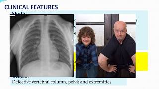 CLEIDOCRANIAL DYSPLASIA Aetiology Clinical Features Oral manifestations and Treatment [upl. by Evette]