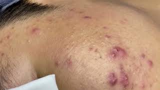 Effective Acne Scar Treatments for Smooth Skin Addressing Cystic Acne Fungal Acne and Hormonal Acn [upl. by Animsaj]