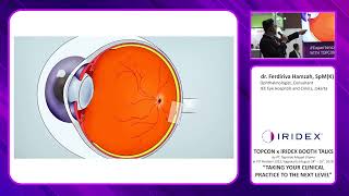 Subthreshold Laser in Chronic Central Serous Chorioretinopathy Ferdiriva Hamzah MD [upl. by Garcon527]