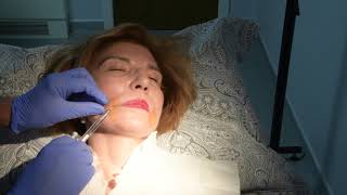 Juvederm injections to nasolabial folds [upl. by Neirrad196]