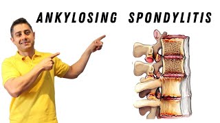 Ankylosing Spondylitis core exercises [upl. by Ettener]