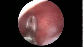 Subglottic foreign body  Dr Jayaprakash Reddy [upl. by Dymoke]