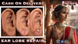 Ear Repair Earlobe  Hole Repair By Ear Pasting lotion  Torn Ear lobe Repaired Earlobe 9687889595 [upl. by Tnahsin]