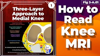 Fig 3A01 ThreeLayer Approach to Medial Knee [upl. by Mikkanen103]