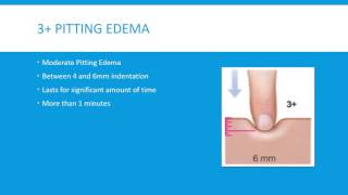 Pitting Edema Grading Scale 4 Levels [upl. by Tildi]