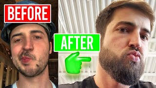 Ultimate Beard Growth Guide Minoxidil amp MicroNeedling [upl. by Nelubez426]