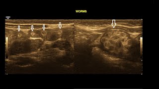 Intestinal Ascariasis  Ultrasound  Case 11 [upl. by Magnolia]