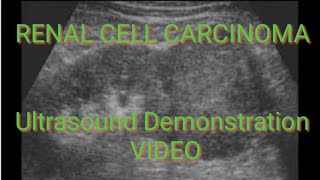 RENAL CELL CARCINOMA on Ultrasound Video Demonstration [upl. by Margit]