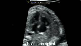 Ecocardiografia fetal Doppler color e insuficiencia tricuspidea Manipulación correcta del PRF [upl. by Tymon837]