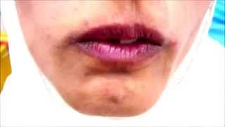 Orofacial Dyskinesia [upl. by Haroppizt173]