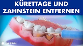 Parodontosebehandlung  Kürettage und Zahnstein entfernen © [upl. by Aiotal]