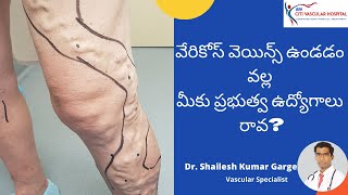 Varicose veins Medical Test  Varicose Veins Government Job Physical and Medical Test In Telugu [upl. by Rimola]