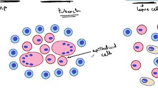 GENERAL PATHOLOGY 36  Tissue reactions in different types of granulomas DR SAMEH GHAZY [upl. by Enttirb413]