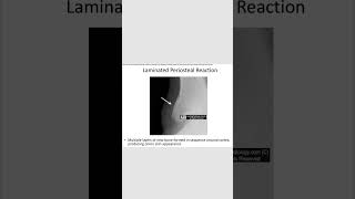 Laminated periosteal reactionradiology revision neetpg inicet [upl. by Eeleimaj442]