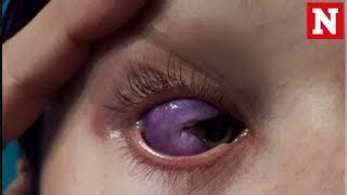 Bizarre eyeball tattoo leaves Canadian model partially blind [upl. by Walton]