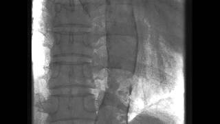 Dense Calcification in the Aorta [upl. by Acey327]