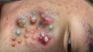 Big Cystic Acne Blackheads Extraction Blackheads amp Milia Whiteheads Removal Pimple Popping  9177 [upl. by Analli479]