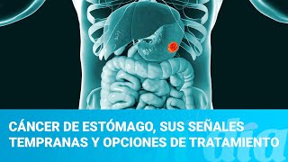 Cáncer de estómago sus señales tempranas y opciones de tratamiento [upl. by Ahsienat586]