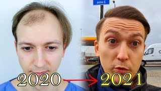 FUE Hair Transplant Growth Timeline  Before amp After [upl. by Tortosa163]