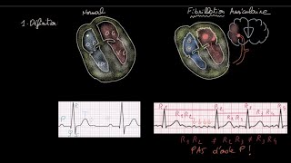 Fibrillation auriculaire  Définition  Impact  Evaluation  Anticoag  HH  FC  Rythme [upl. by Haidabez136]