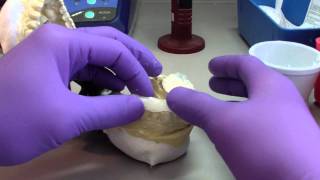 Bruxism Splint  Part 4  Developing the Occlusal Surface [upl. by Birkett]