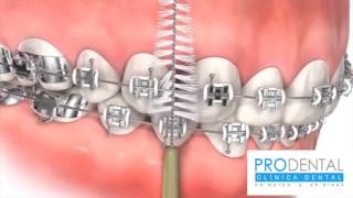 ¿Cómo lavarse correctamente los dientes con brackets [upl. by Eneluqcaj]