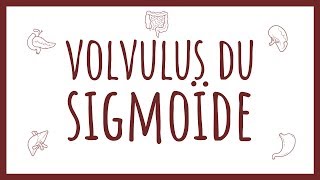 Sémiologie Chirurgicale  Volvulus du Sigmoïde [upl. by Ahsirhcal]