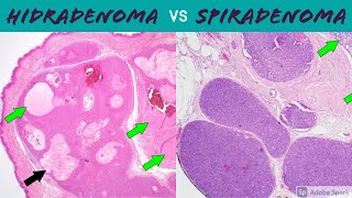 Hidradenoma Acrospiroma vs SpiradenomaCylindroma 5Minute Pathology Pearls [upl. by Ona]