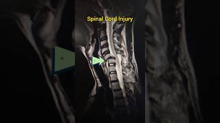 Spinal Cord Injury [upl. by Hole]