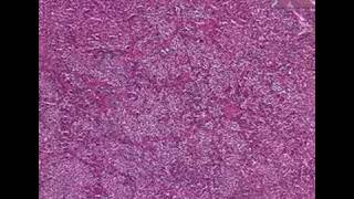 Histopathology PituitaryAcidophilic adenoma [upl. by Slyke563]