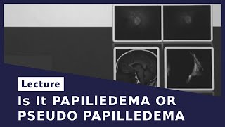 Is It PAPILlEDEMA OR PSEUDO PAPILLEDEMA [upl. by Kato310]