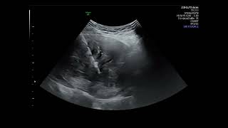 Ultrasound guided microwave ablation for uterine myoma [upl. by Beryl975]