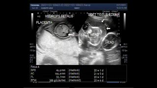 Twin Pregnancy of about 21 weeks with one fetus normal and the other with Hydrops Fetalis [upl. by Nhguavaj578]