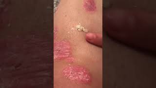 1st psoriasis peel [upl. by Dadirac]