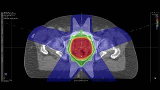 MedPhys  142  IMRT amp VMAT Inverse planning [upl. by Enrev140]