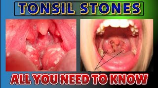 Tonsil Stones  Tonsil Stones Treatment  Tonsil Stone Removal  All You Need to Know [upl. by Nogam534]