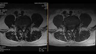 L45 Disc extrusion with mild inferior migration [upl. by Maurise]