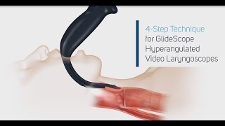 How to Intubate Using a GlideScope® Video Laryngoscope in 4 Steps [upl. by Annej]