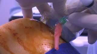 WATCH a Knee Joint Injection  LIVE [upl. by Ativak]