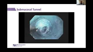 Third Space Intraluminal Endoscopy Webinar [upl. by Astrahan]