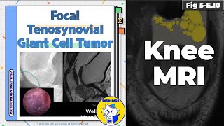 Fig 5E10 Localizedtype Tenosynovial Giant Cell Tumor [upl. by Yboj]