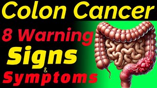 Colon Cancer Warning Signs  8 Warning Signs Of Colon Cancer  Colorectal Cancer  Bowel Cancer [upl. by Akener]