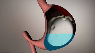 The Allurion Swallowable Gastric Balloon  How it works [upl. by Manoff]