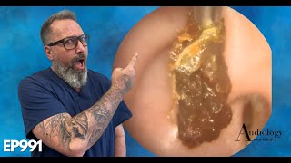 HOW TO SAFELY REMOVE A HUGE EAR WAX PLUG Earwax removal  EP991 [upl. by Eniahs926]